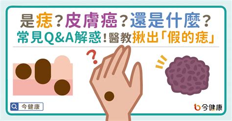 痣長毛代表什麼|是痣？皮膚癌？還是什麼？常見Q&A解惑！醫教揪出「。